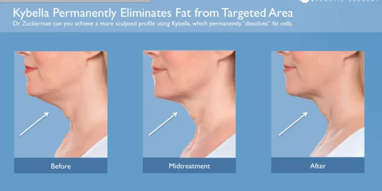 Double Chin